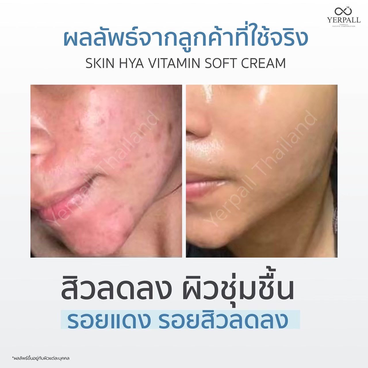 YERPALL - INTENSIVE SKIN HYA SOFT CREAM